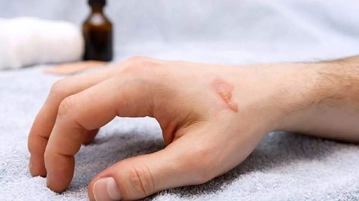 ​​​​​​​باورهای اشتباه در برخورد با سوختگی بدن