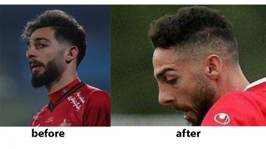 تغییر چهره عجیب گلزن پرسپولیس در دربی پس از جراحی پلاستیک