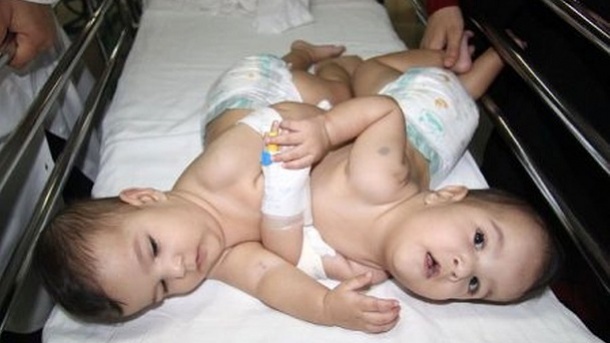 جزییات جراحی جداسازی خواهران دوقلو در شیراز